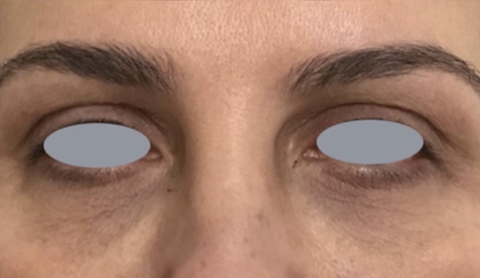 Tratamiento de las arrugas perioculares con láser- despues
