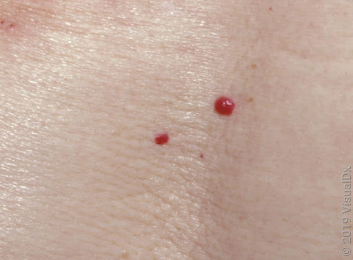 Angiomas o puntos rubí