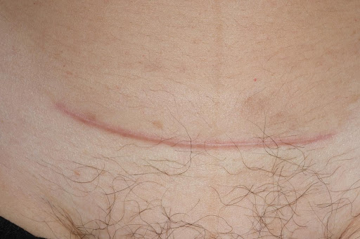 Cicatrices quirúrgicas