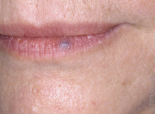 Lago venoso del labio