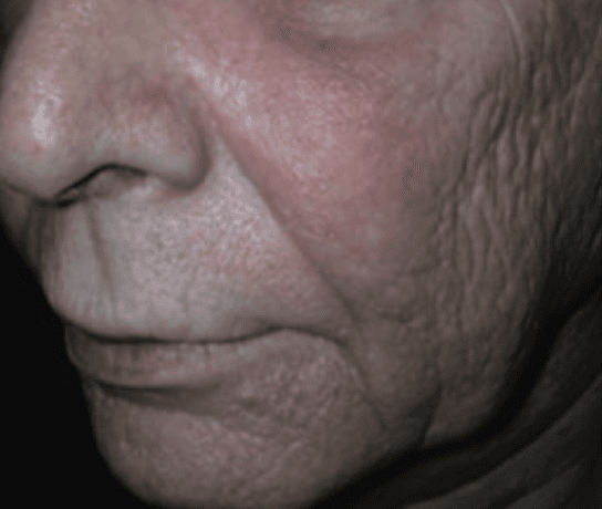 Tratamiento arrugas finas con laser