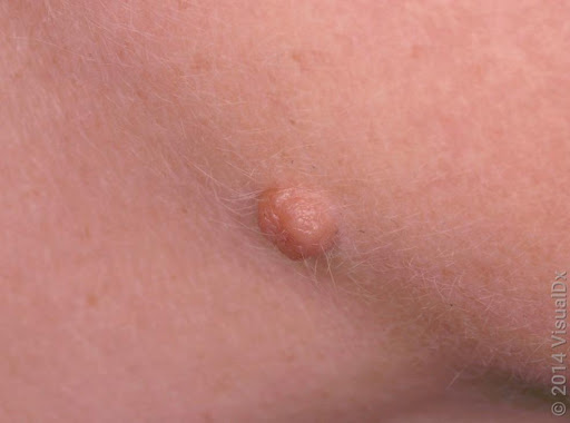 nevus